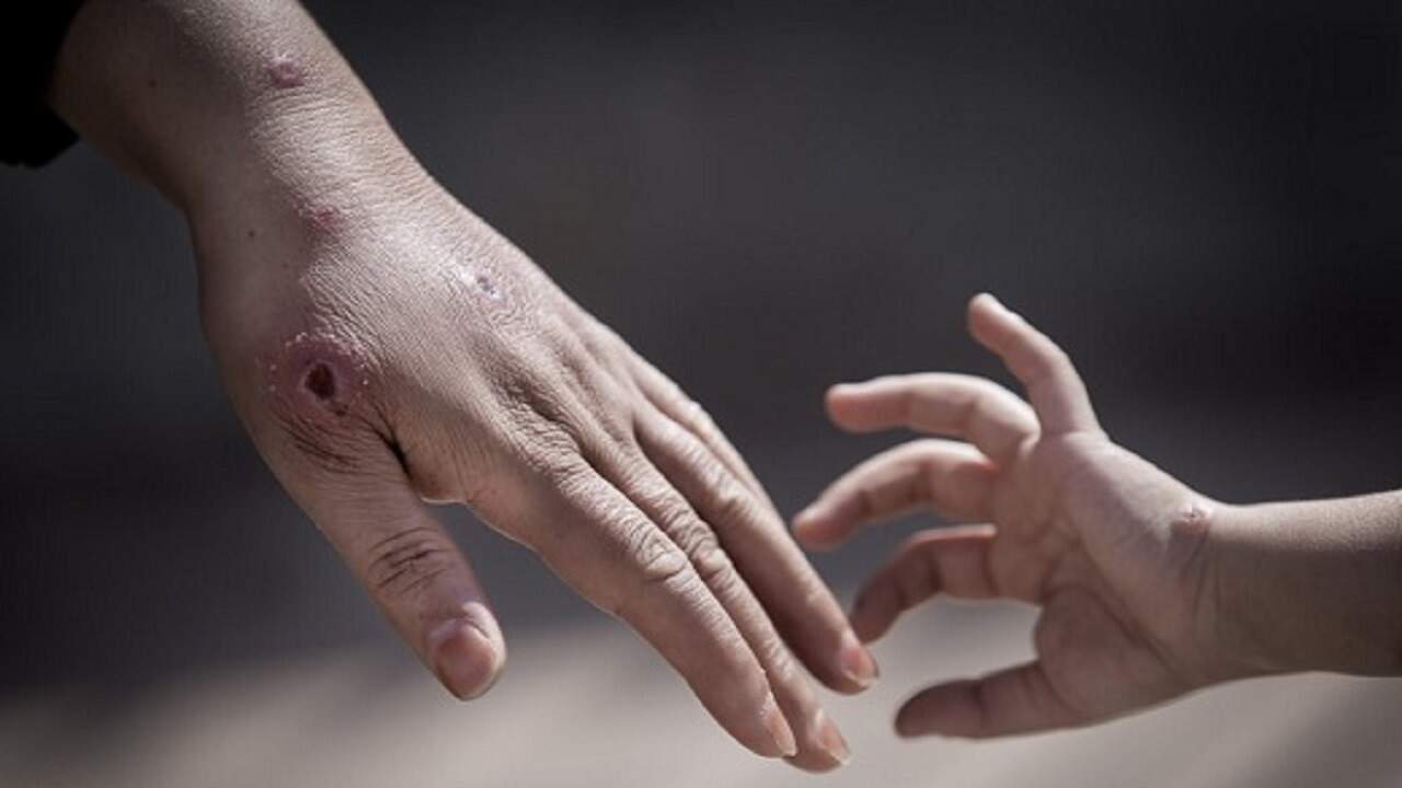 شیوع بیماری سالک در مناطق شمالی تهران به دلیل نگهداری سگ و گربه